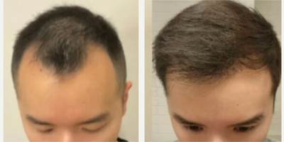Hair Transplant before and after photo