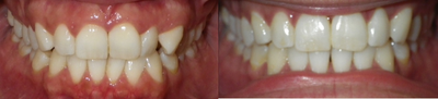 Invisalign before and after photo