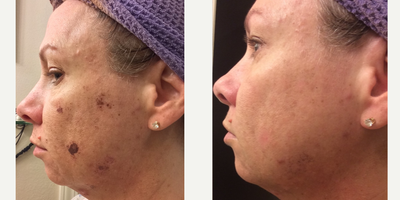 IPL before and after photo