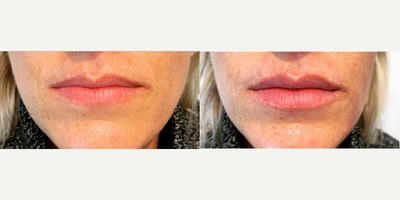 Juvederm before and after photo