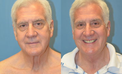 Neck Lift before and after photo