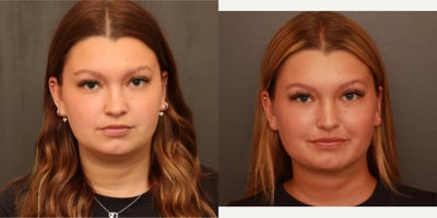 Neck Lift before and after photo