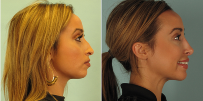 Rhinoplasty before and after photo