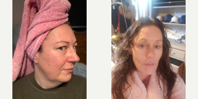Chemical Peel before and after photo