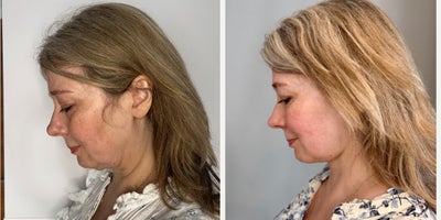 Facelift before and after photo