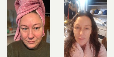 Microneedling before and after photo
