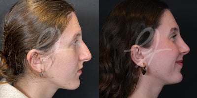 Rhinoplasty before and after photo
