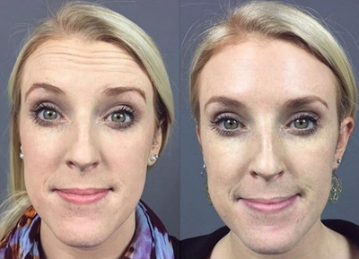 Botox before and after photo