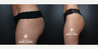 Emsculpt before and after photo