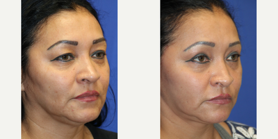 Facelift before and after photo
