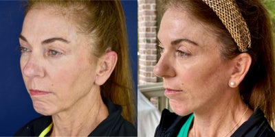 Facelift before and after photo