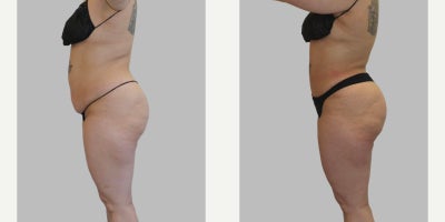 Liposuction before and after photo