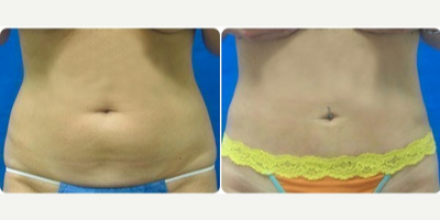 Smart Lipo before and after photo