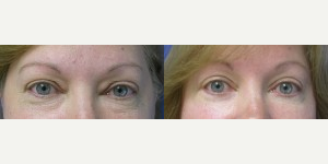 Brow Lift before and after photo
