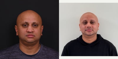 Revision Rhinoplasty before and after photo