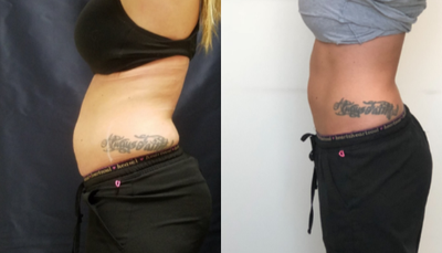SculpSure before and after photo