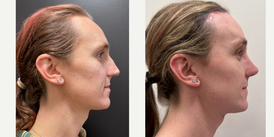 Transgender Facial Feminization Surgery before and after photo