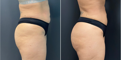 Brazilian Butt Lift before and after photo