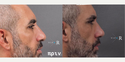 Revision Rhinoplasty before and after photo
