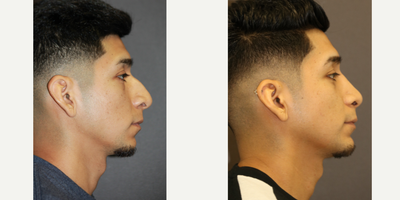 Rhinoplasty before and after photo