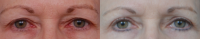 Eyelid Surgery before and after photo