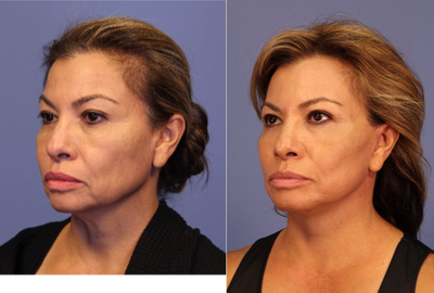 Facelift before and after photo
