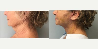before and after image