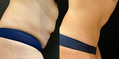 Liposuction before and after photo