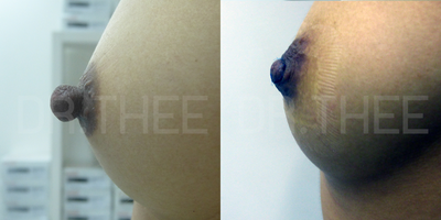 Nipple Reduction before and after photo