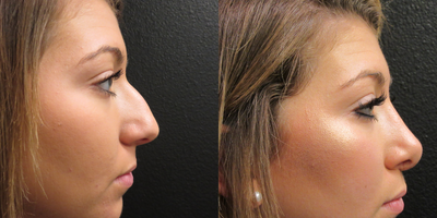Rhinoplasty before and after photo