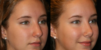 Rhinoplasty before and after photo