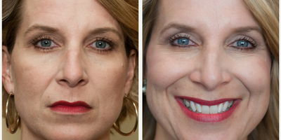 Eyelid Surgery before and after photo