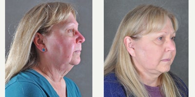 Eyelid Surgery before and after photo