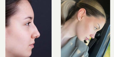 Septoplasty before and after photo