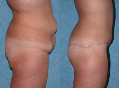 Butt Augmentation before and after photo