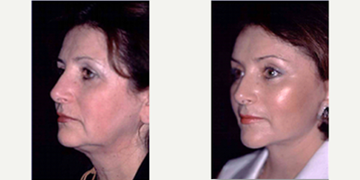 Facelift before and after photo