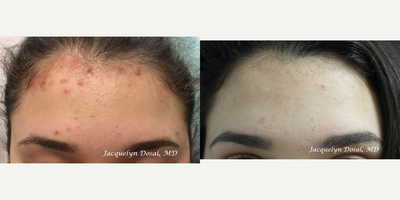 Fraxel Laser before and after photo