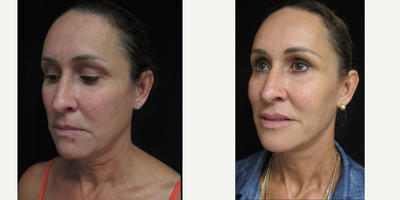 Neck Lift before and after photo