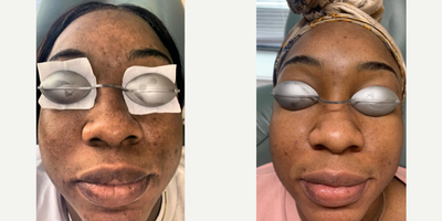 Chemical Peel before and after photo
