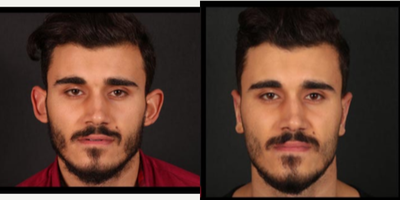 Ear Surgery before and after photo