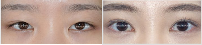 Eyelid Surgery before and after photo