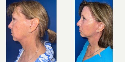 before and after image