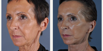 Facelift before and after photo