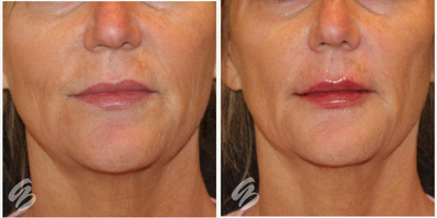 Lip Fillers before and after photo