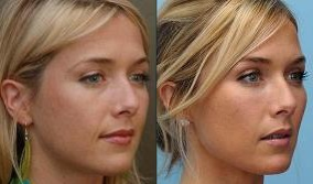 Restylane before and after photo