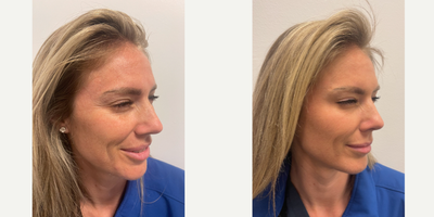Botox before and after photo