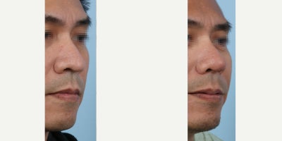 Asian Rhinoplasty before and after photo