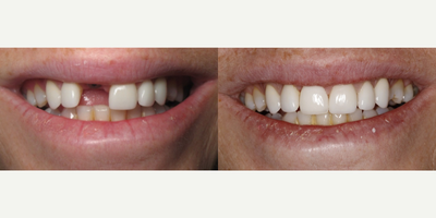 Dental Implants before and after photo