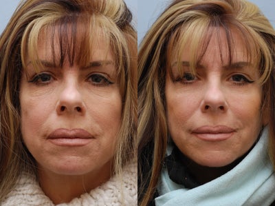 Eyelid Surgery before and after photo