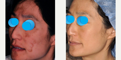 Laser Peel before and after photo